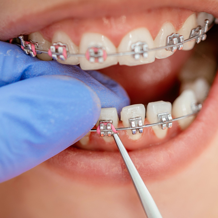Woman receiving orthodontic treatment at a dental clinic in Stafford, VA