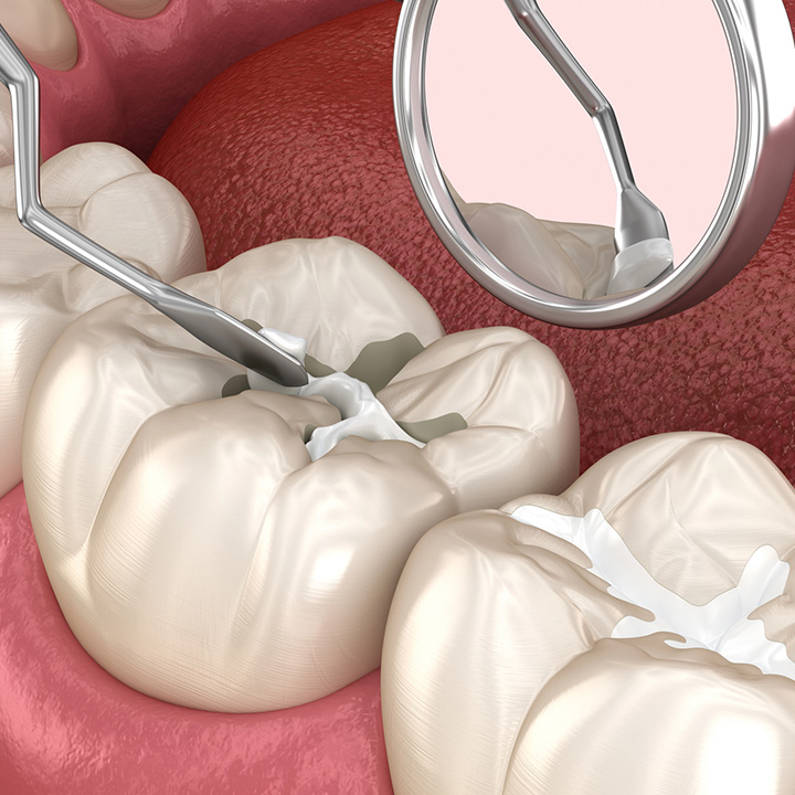 Dental sealants procedure for cavity prevention in Stafford, VA