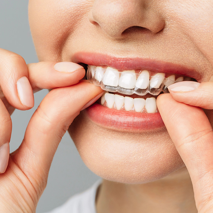 Woman showing her Invisalign clear aligners at a dental clinic in Stafford, VA