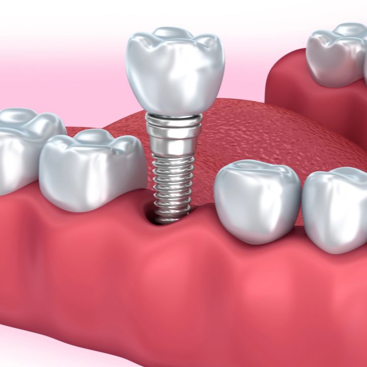 Ceramic Dental Implants Stafford VA